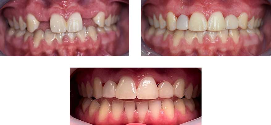 Resin Bonding of upper two front teeth - Carroll Dental Care