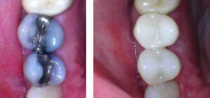 Same day dental crown procedure by Dr. Gallagher in Westminster Carroll County Maryland before/after