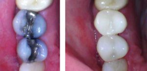 Same day dental crown procedure by Dr. Gallagher in Westminster Carroll County Maryland before/after