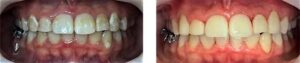 Same day dental crown procedure by Dr. Gallagher in Westminster Carroll County Maryland before/after