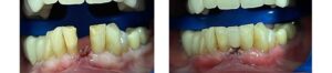 Same day dental crown procedure by Dr. Gallagher in Westminster Carroll County Maryland before/after