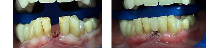 Resin Bonding of upper two front teeth - Carroll Dental Care