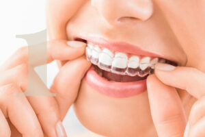 Invisalign clear aligners at Gallagher & Kuhn Dental Group, Westminster, Carroll County, MD