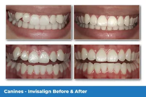 Gallagher & Kuhn Dental Group helping patients straighten teeth with Invisalign in Westminster