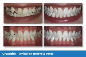Gallagher & Kuhn Dental Group helping patients straighten teeth with Invisalign in Westminster