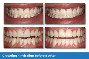 Gallagher & Kuhn Dental Group helping patients straighten teeth with Invisalign in Westminster
