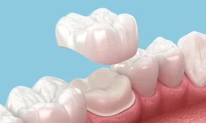 Dental crown procedure at Gallagher & Kuhn Dental Group, Westminster, Carroll County, MD