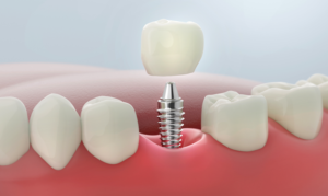 Dental implant procedure at Gallagher & Kuhn Dental Group, Westminster, Carroll County, MD