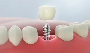 Dental implant procedure at Gallagher & Kuhn Dental Group, Westminster, Carroll County, MD