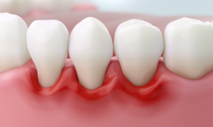 Gallagher and Kuhn - Treating Gum Disease