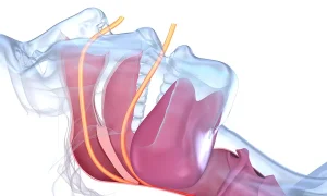 Sleep apnea treatment at Gallagher & Kuhn Dental Group, Westminster, Carroll County, MD